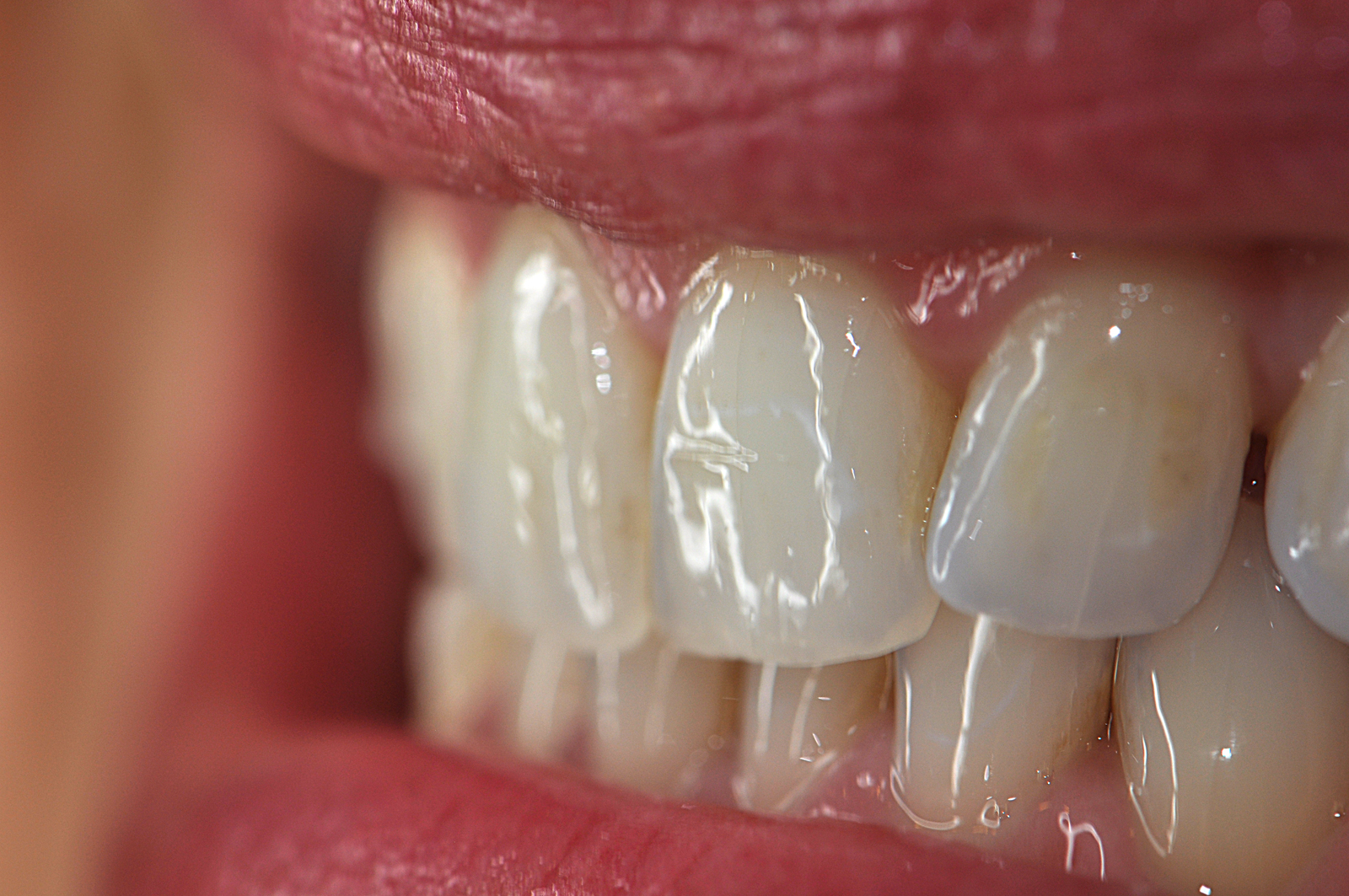 Photography, Dental; Photography, Intraoral