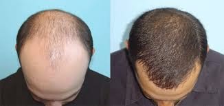 If you suffer from hair loss, you MUST try Provillus