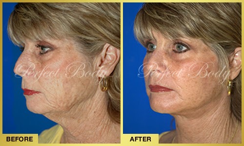 What is a laser neck lift?