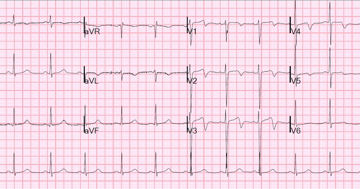 Dr. Smith's ECG Blog: Wellens' waves are NOT equivalent to Wellens