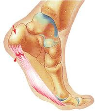 Mi lesion: Fascitis plantar