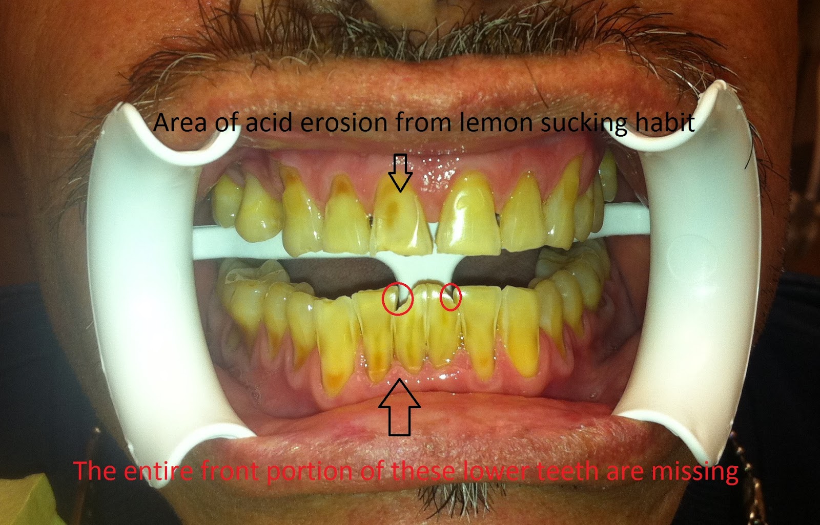 Wheaton Dentist Lemon sucking