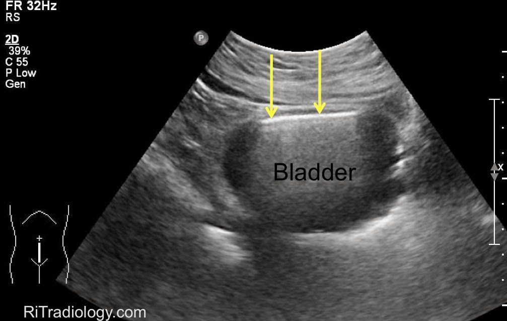 Gangrene fournier necrotizing emj bmj RiT radiology: Emphysematous Cystitis