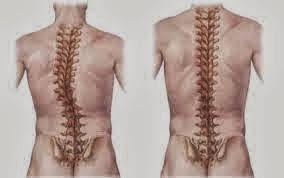 Blogger Belitung Gangguan Dan Penyakit Pada Sistem Gerak