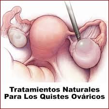 Los Quistes de Ovario
