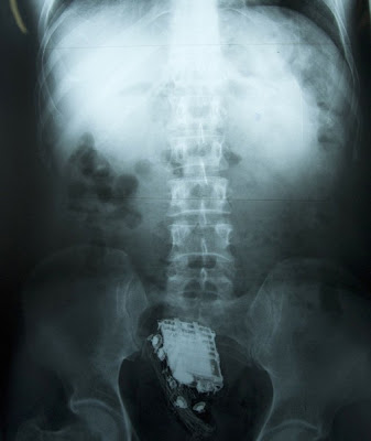 gambar x-ray
