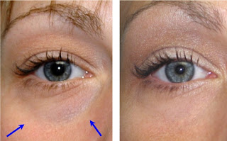 under-eye hollows, SAY NO TO CONCEALERS- OPTIONS TO IMPROVE UNDER-EYE HOLLOWS AND CIRCLES.