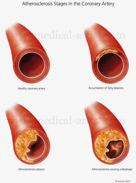 What is the hardening of the arteries, and what are the symptoms?
