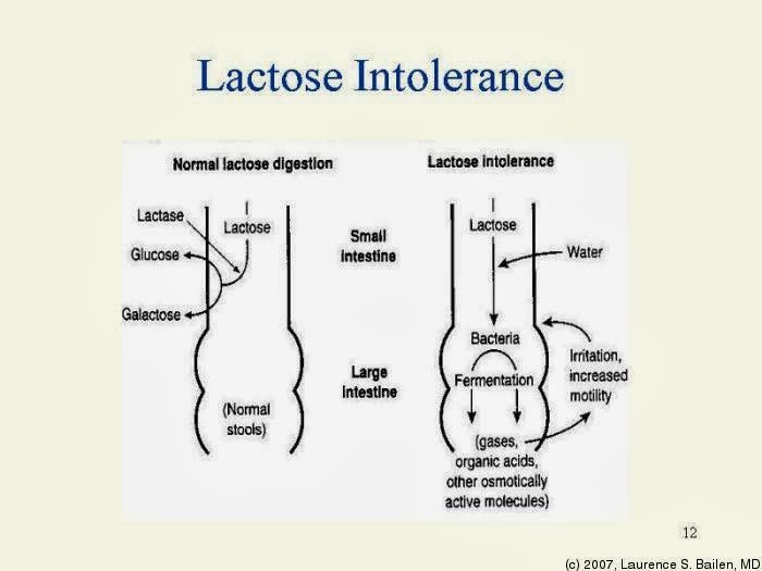 Lactose Intolerance Symptoms, Causes, Diagnosis, Treatment, Nutritions