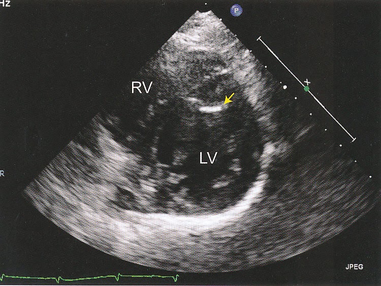 Pedi cardiology Echo artifacts