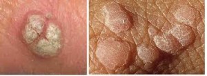 Bintik Kasar di Vagina obat Bintik Kasar di Vagina