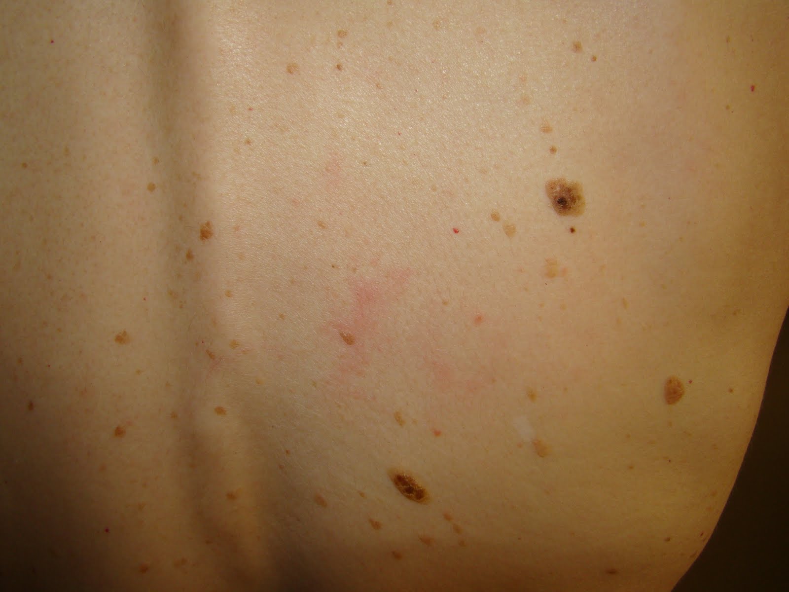 My Journey With Candida Blog: Marks On My Skin ~ Are These Liver Spots 
