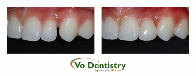 composite, tooth colored, fillings, space close, orthodontic treatment, cosmetic dentistry, Vo Dentistry, Lawrenceville, Norcross, Lilburn, Dacula, buford, duluth, snellville, hamilton mill, grayson, sugar hill, sugar loaf, GA, Georgia, 30019, 30044, 30045