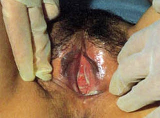 vaginal infections, infections vaginal, vagina discharge, cause of yeast infection, causes yeast infection, vaginal infection yeast, home remedy for yeast infection, yeast infection home remedy, treatment of vaginitis, treatment of bacterial vaginosis, treatment bacterial vaginosis, infections of vagina, infections of the vagina, vagina infections, vaginal irritation