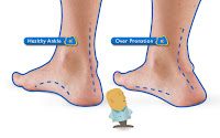 Foot Pronation
