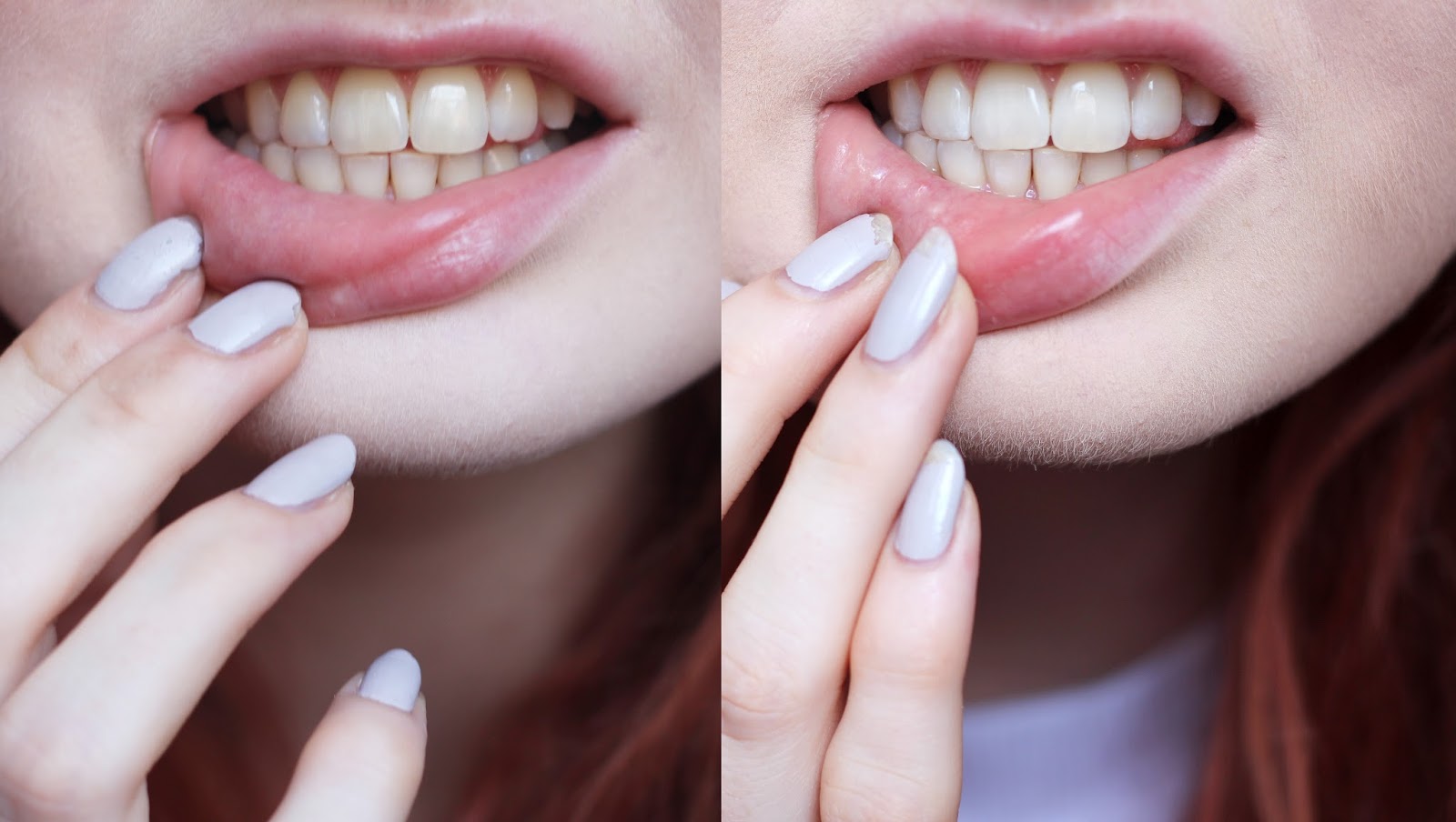 Does Home Teeth Whitening Work? Smile Brilliant Review Hannah