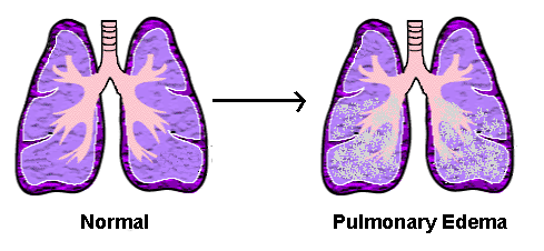 MEDICINA, SALUD Y CURIOSIDADES EDEMA PULMONAR