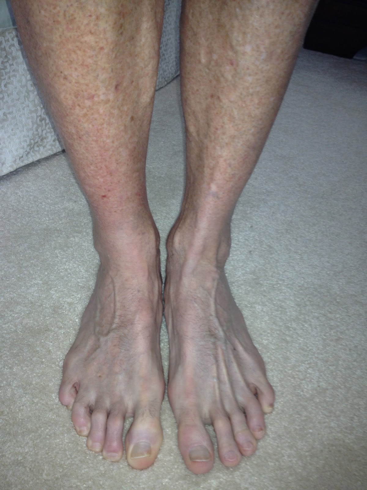 Navicular Bone Fracture An Old Guys Triathlon Experiences-3.bp.blogspot.com