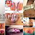 Obat Wasir Ijin BPOM Ampuh Di Jamin Aman thumbnail