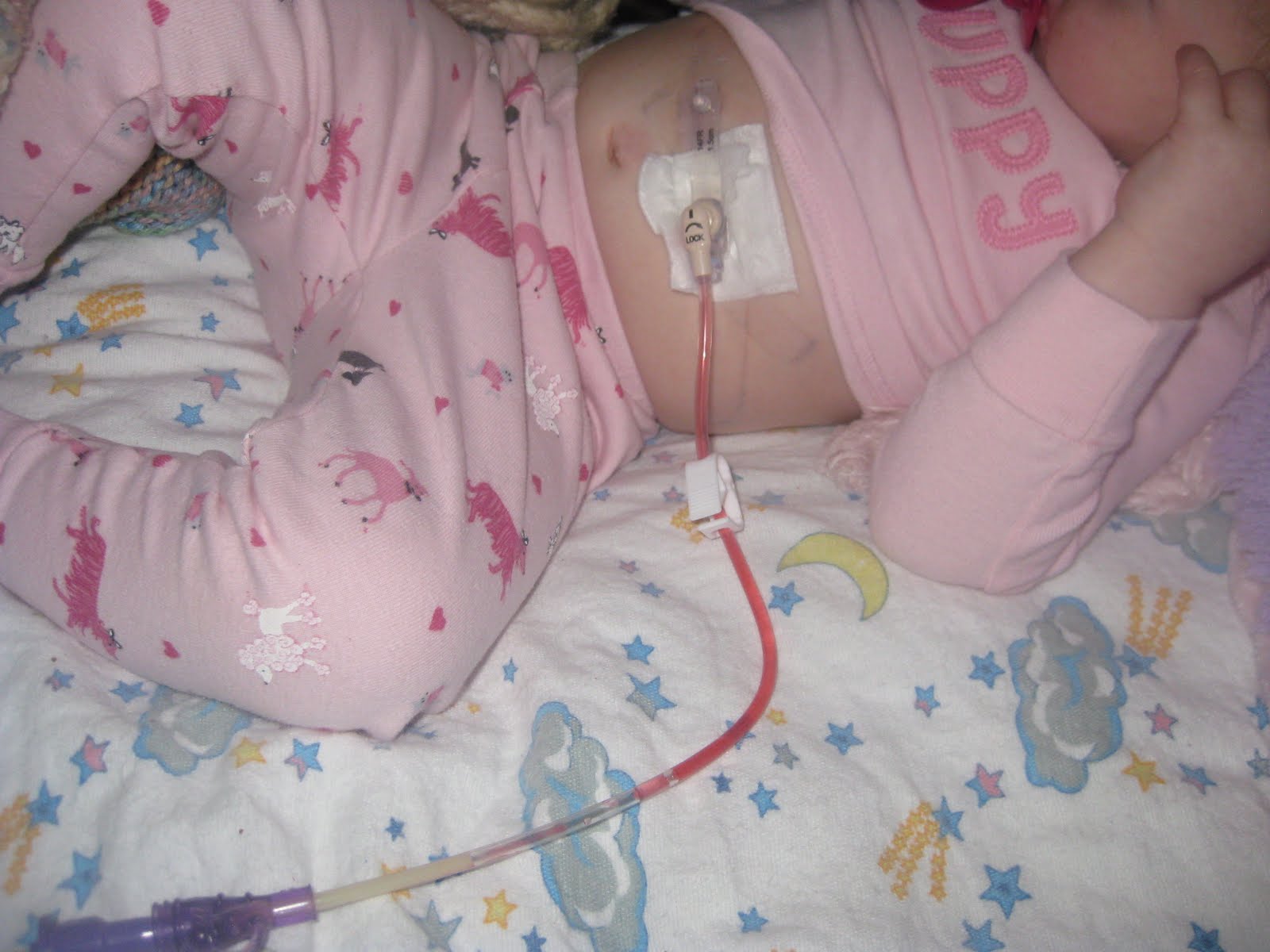 Ad Silvam Ibimus Feeding Tube Awareness Week