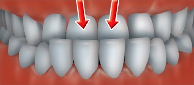 Chirurgie underbite