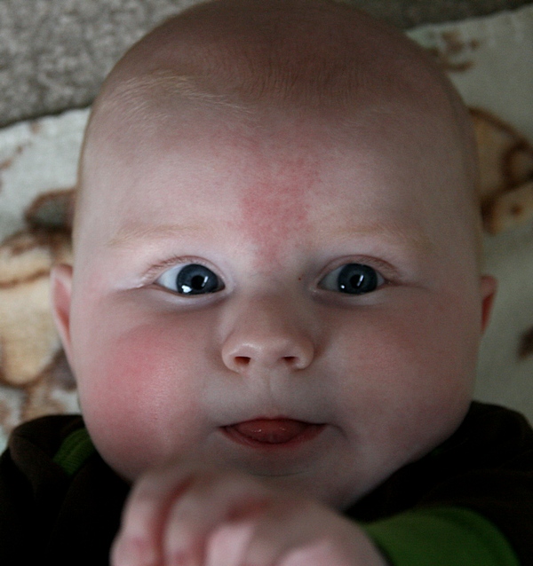 Bountiful Butterflies Today's Lesson Birthmarks