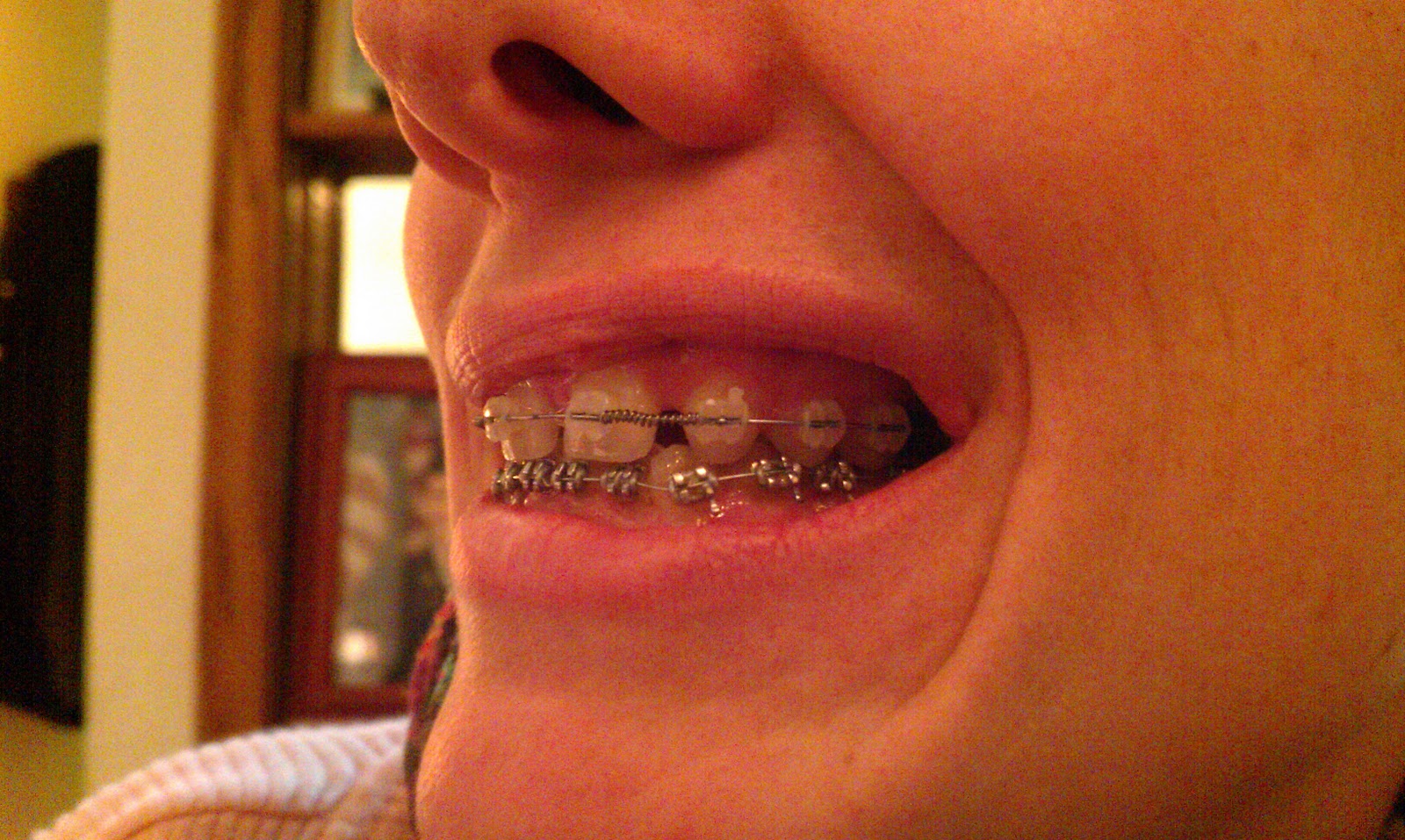 Operation New Smile Missing top lateral incisors Life with braces II...