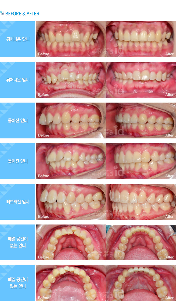 ID Hospital Korea [ID Hospital In The News] Find Your Smile With ID