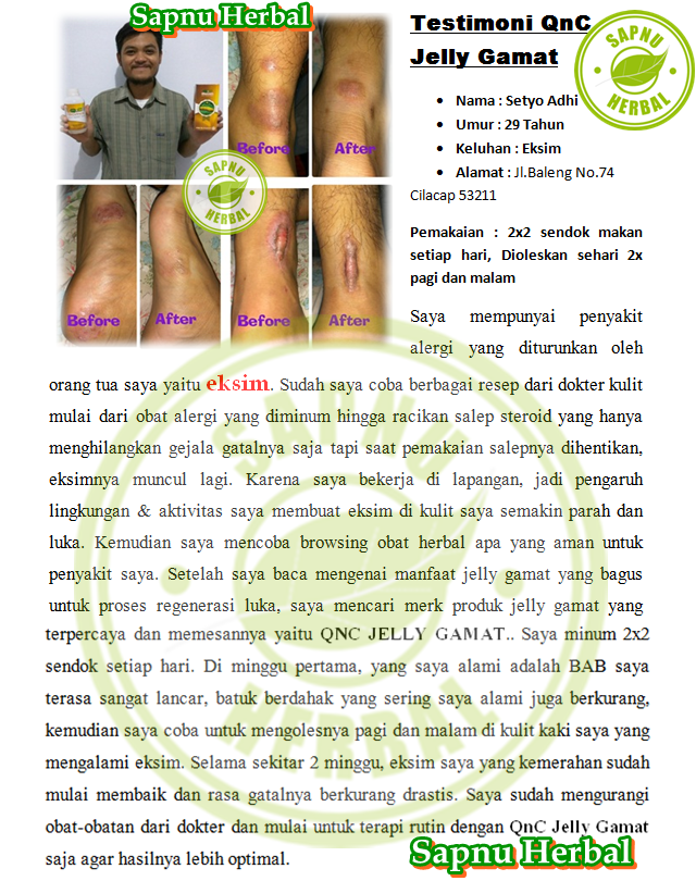 Cara Menyembuhkan Dermatitis Di Wajah Terampuh , TERBUKTI Mujarab!! Cara Menyembuhkan Dermatitis Di Wajah Terampuh , TERBUKTI Mujarab!!