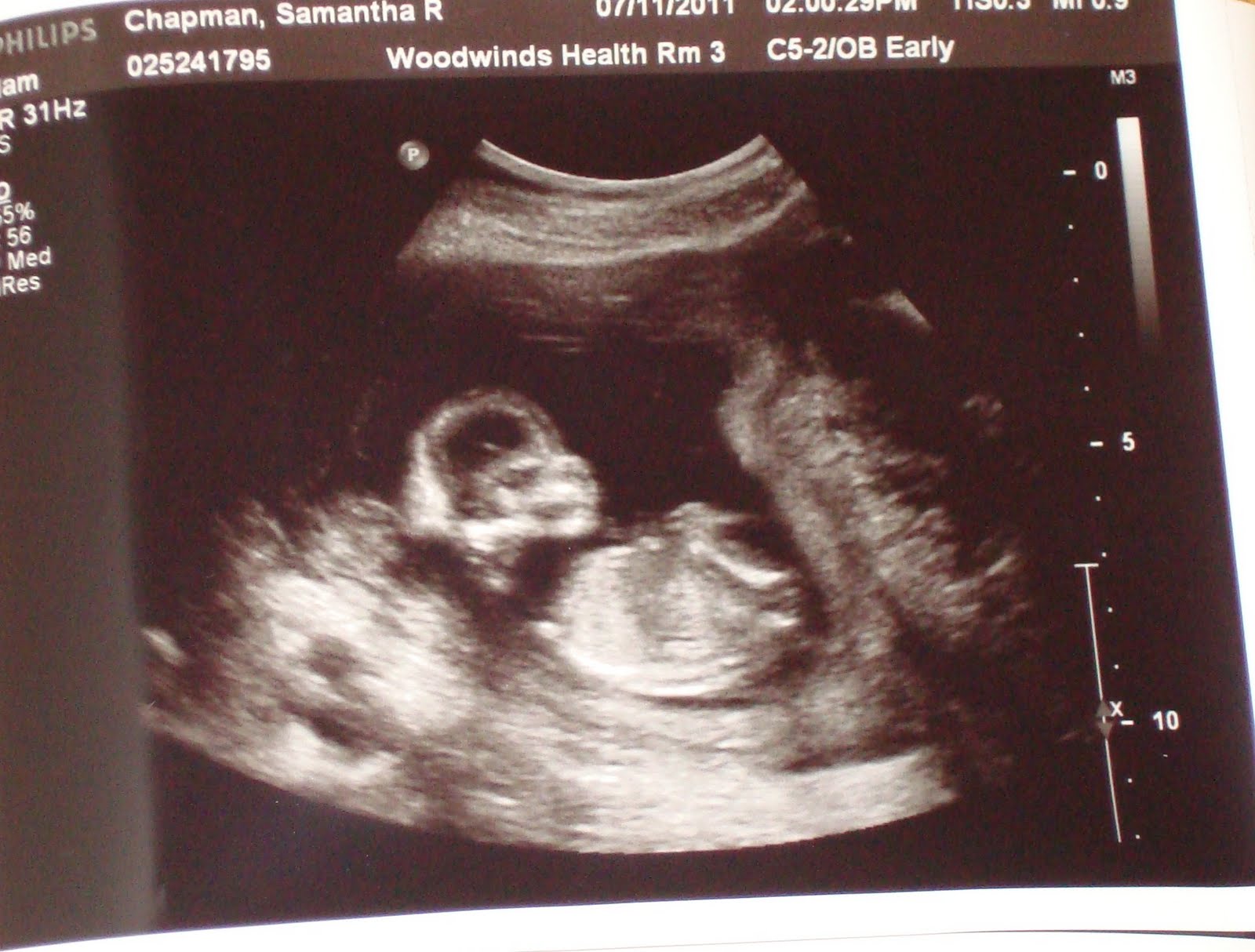 11 weeks 5 days pregnant symptoms gone, maternity insurance qatar, baby