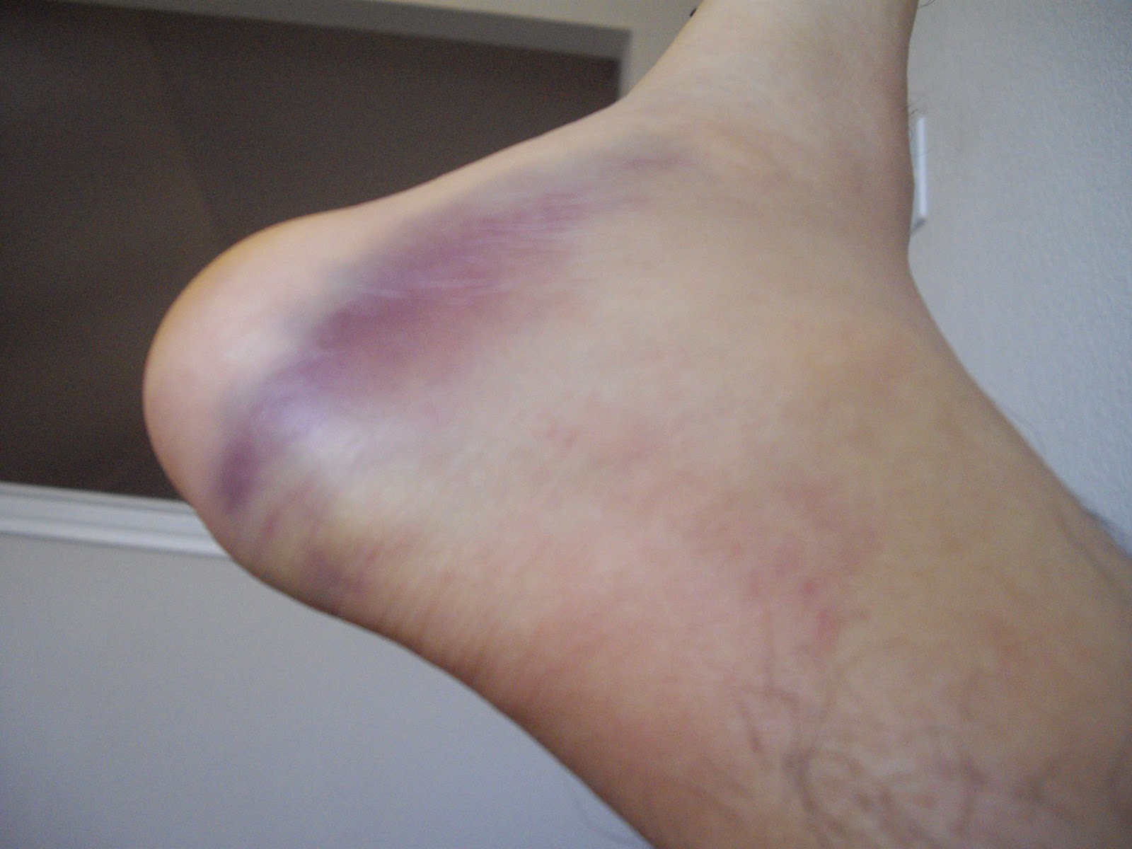 Swollen Achilles Tendon