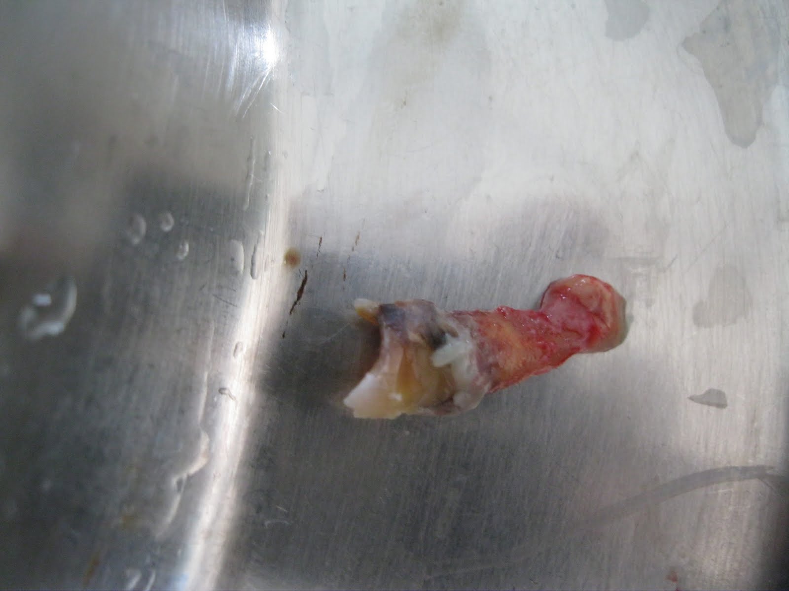 cyst radicular dental extraction care dento clinics