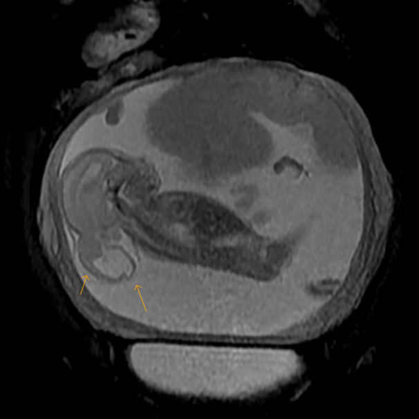 Occipital Encephalocele Fetal MRI Sumer's Radiology Blog