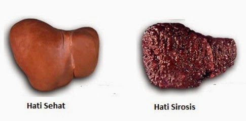 Obat Sirosis Hati Herbal Obat Sirosis Hati Herbal