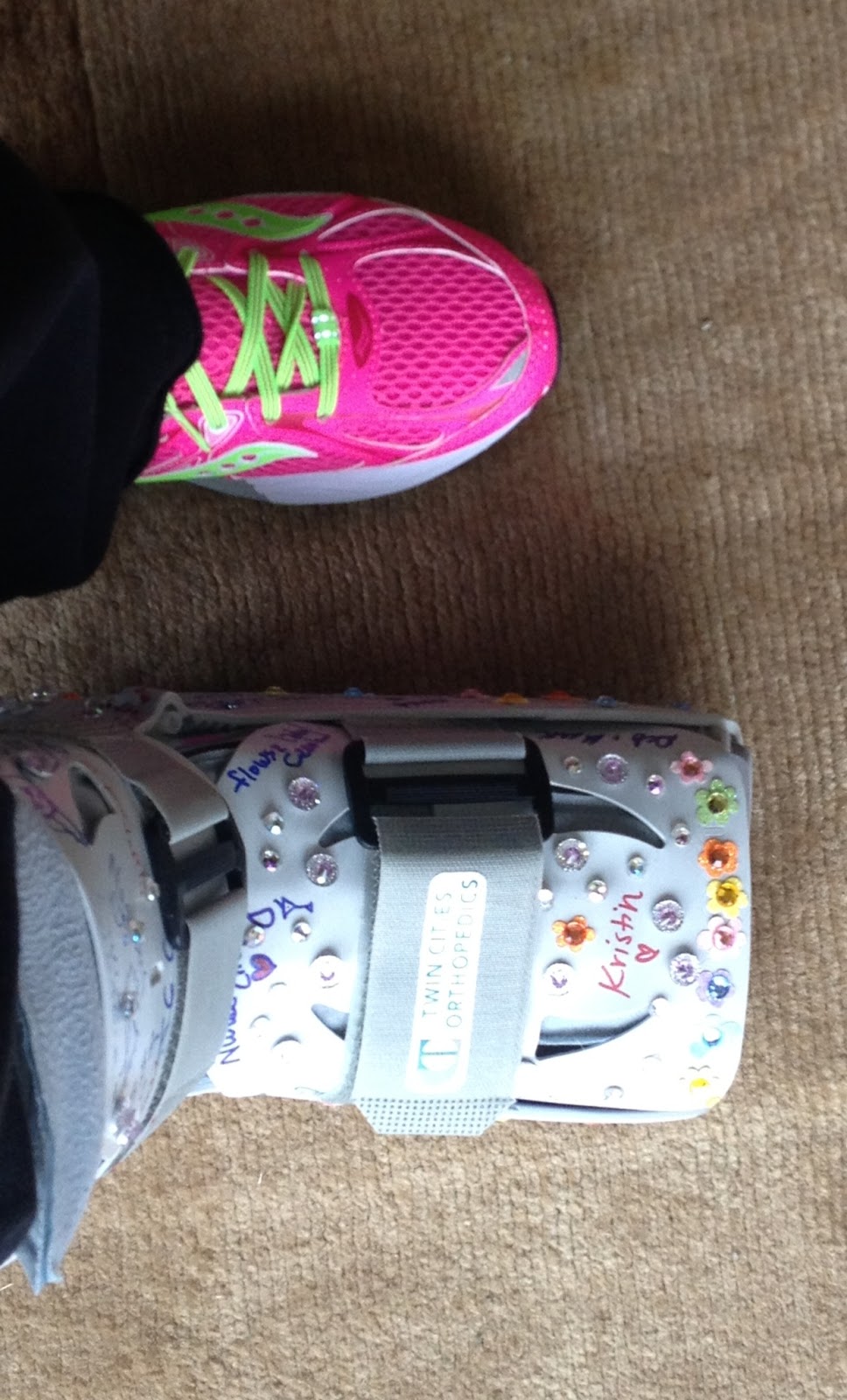 After LisFranc Surgery Transitioning from non weight bearing to