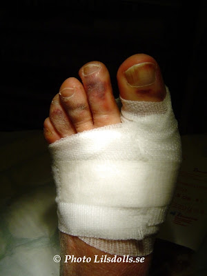 hallux valgus, halluxvalgus-operation, byte av gips