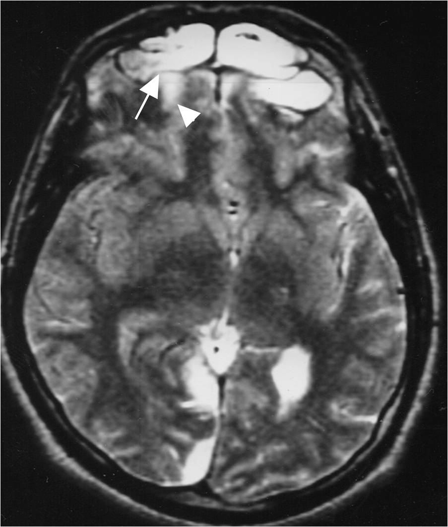 RESONANCE IMAGING OF BRAIN MRI BRAIN