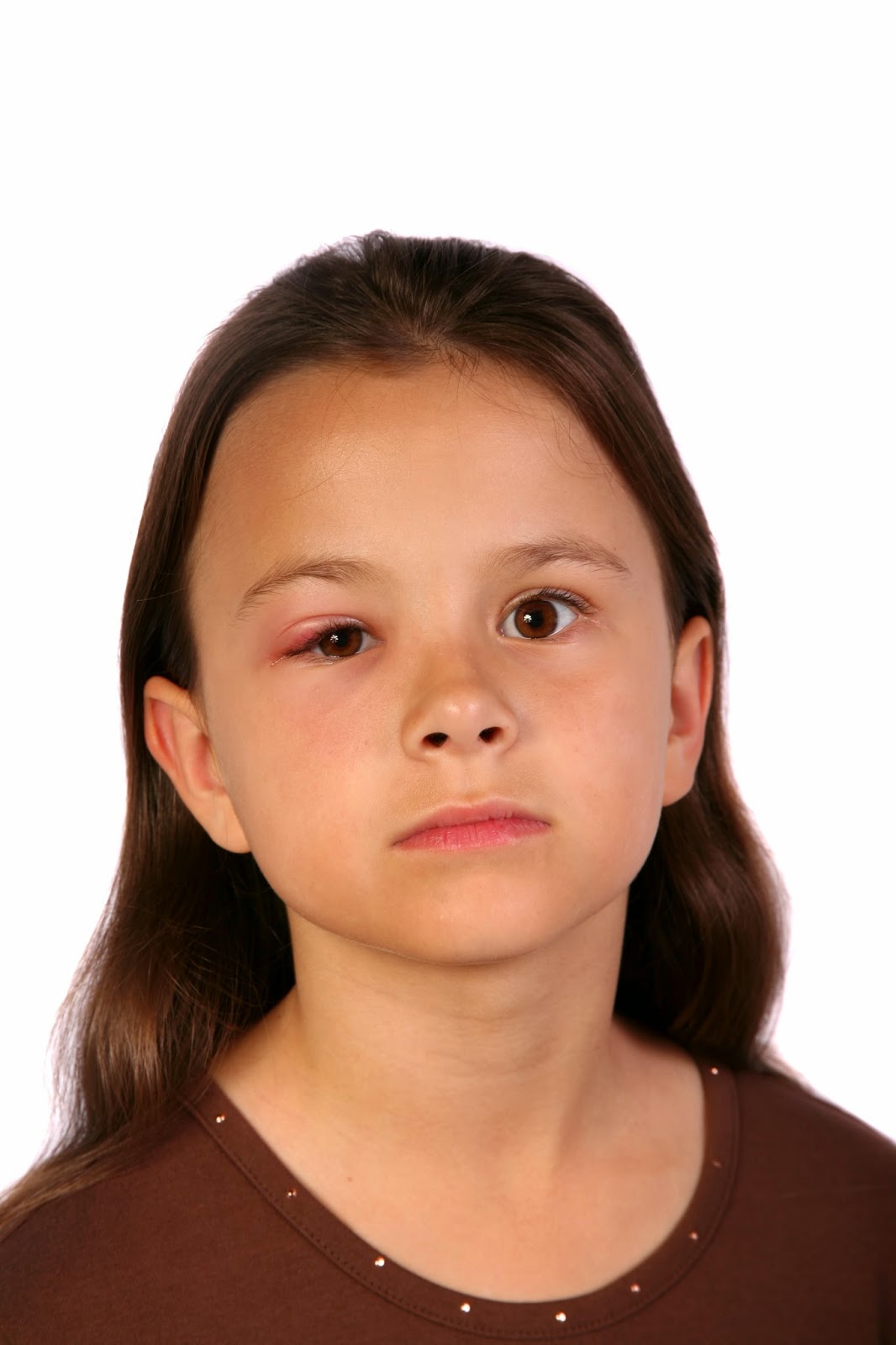 Quest for Health Swollen Eyelids Causes, Treatments, and When to Worry