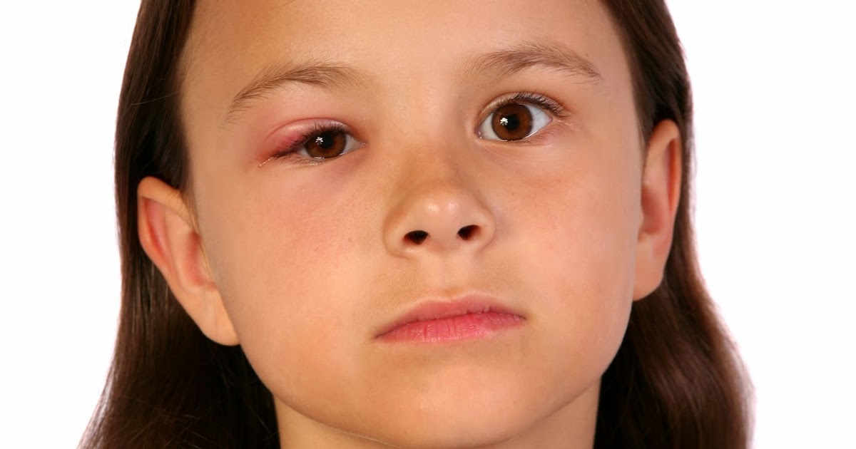 Quest for Health Swollen Eyelids Causes, Treatments, and When to Worry