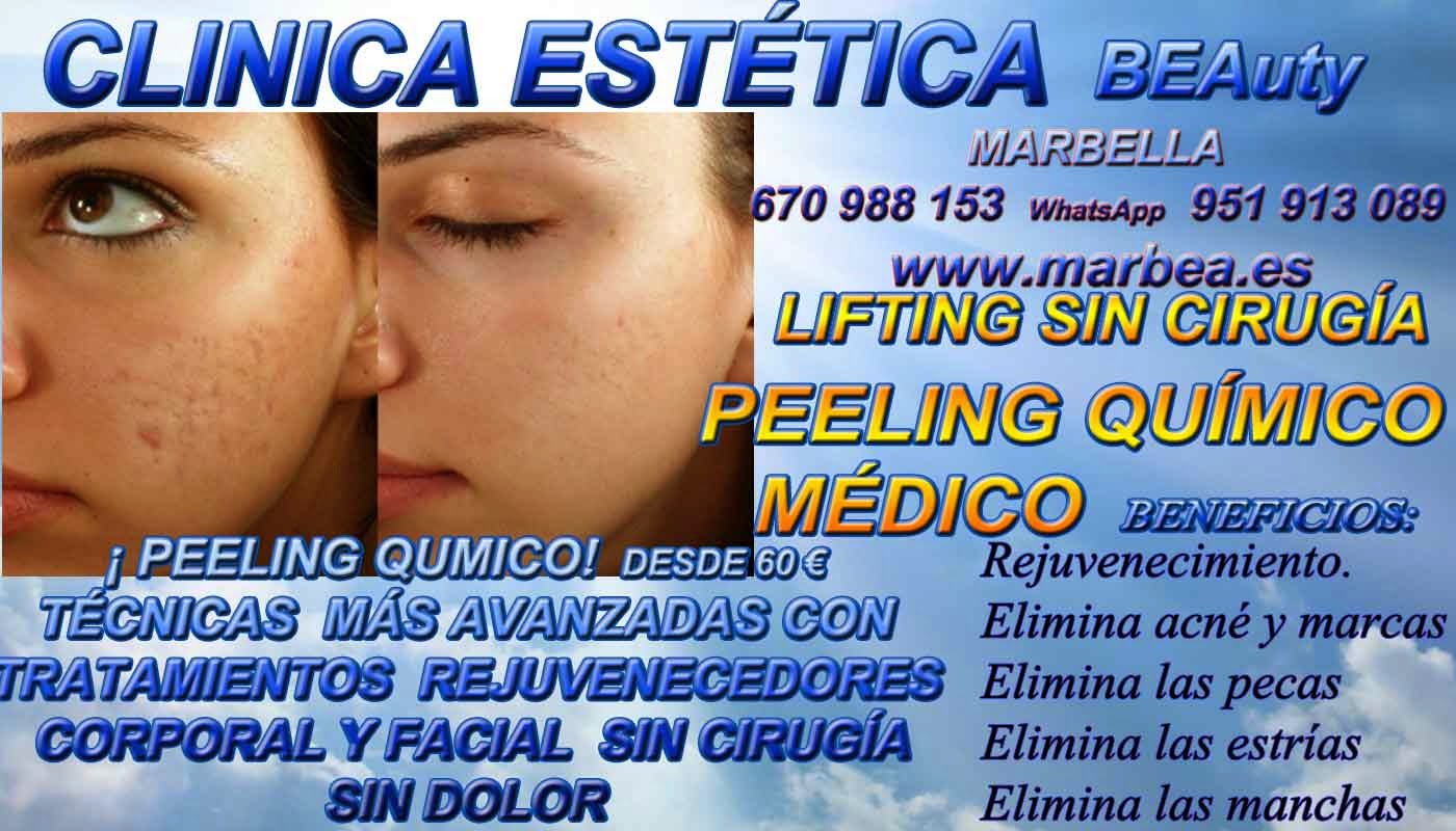 MARBELLA PEELING FACIAL QUIMICO MARBELLA PEELING FACIAL QUIMICO MEDICO PARA ELIMINACIÓN , QUITAR , TRATAMIENTO: ACNÉ , MARCAS , CICATRICES , MANCHAS ,PECAS , ESTRÍAS , MANCHAS