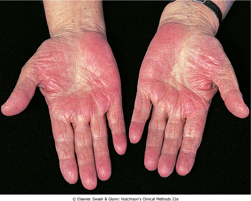 Rash on palms of hands lupus