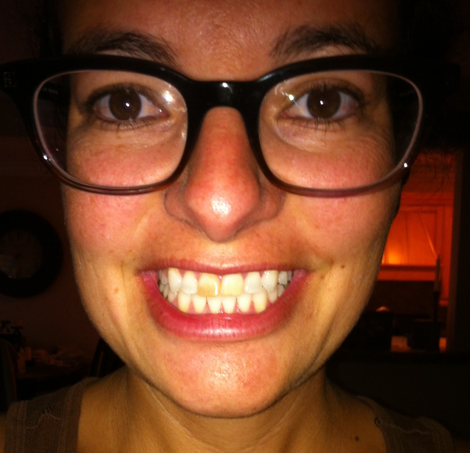 Braceface The Sequel (a jaw surgery and braces blog) BOOM Braces