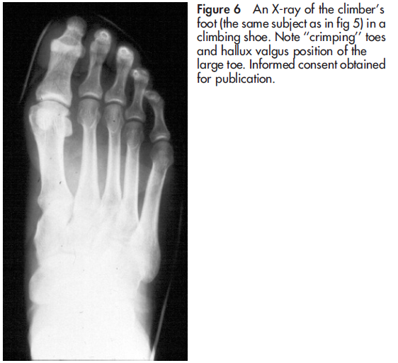 Tom's Physiotherapy Blog: Feet and rock climbing