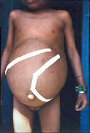 Liver Enlarged
