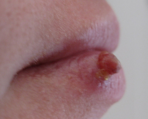 HAMİLELİKTE DUDAK VE DAMAKTA YARA, ŞİŞLİK (PİYOJENİK GRANÜLOMA)