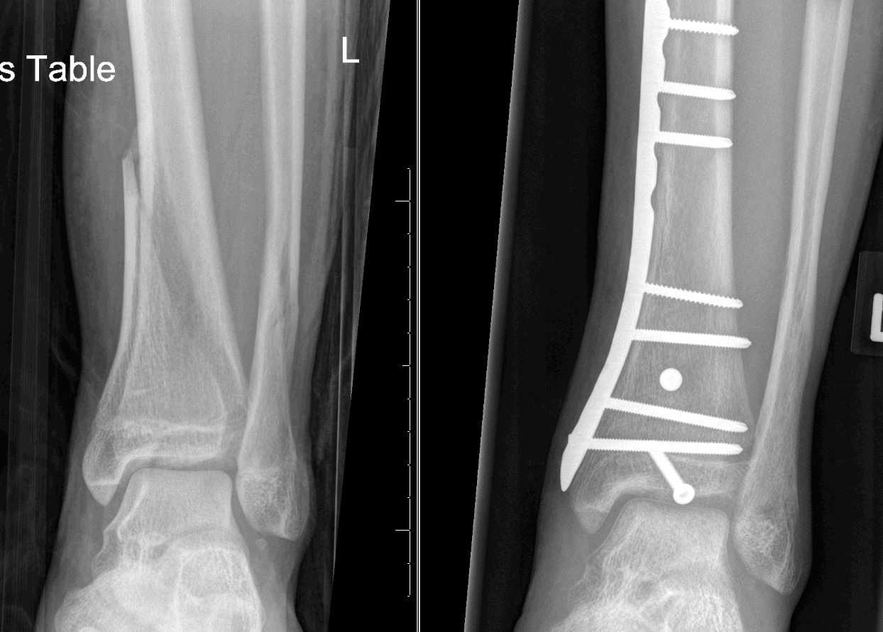Cpt Orif Tibial Plafond Fracture vrogue.co