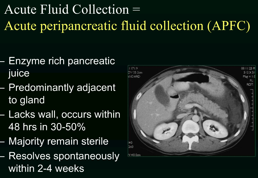 rsna Acute pancreatitis