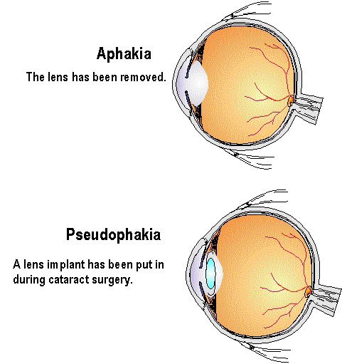 photos for aphakia and pseudophakia young doctors research forum pseudophakia