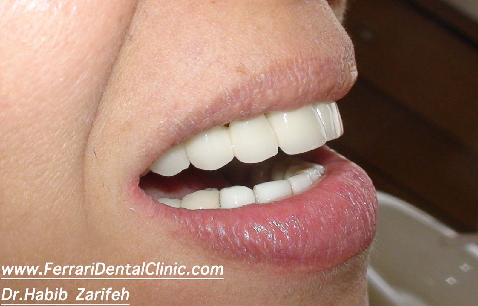 Dental implants Lebanon specialist Dr.Habib Zarifeh