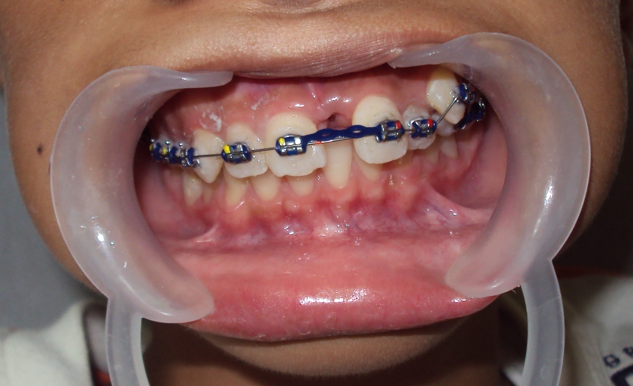 TOOTHFULNESS Got Extra Tooth